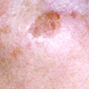About Face Advanced Electrolysis - Age Spots / Sun Spots / Liver Spots - Solar Lentigines