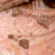 About Face Advanced Electrolysis - Dermatosis Papulosa Nigra