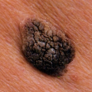 About Face Advanced Electrolysis - Seborrhoeic Wart