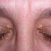 About Face Advanced Electrolysis - Xanthelasma