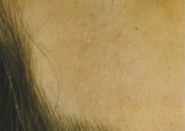 Milia After - About Face Glasgow - Advanced Electrolysis Cosmetic Procedures