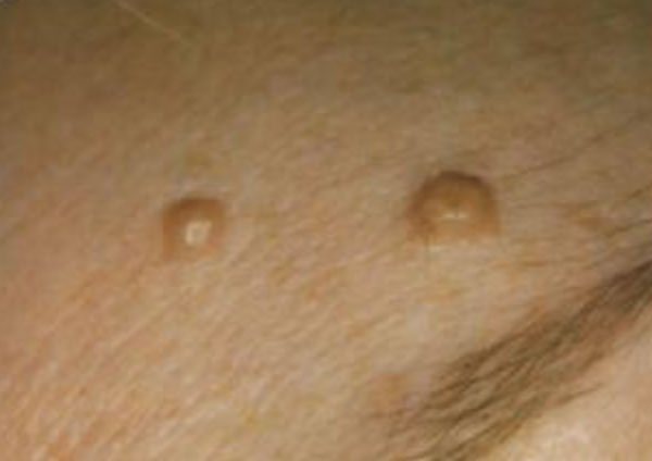 Moles Before - About Face Glasgow - Advanced Electrolysis Cosmetic Procedures