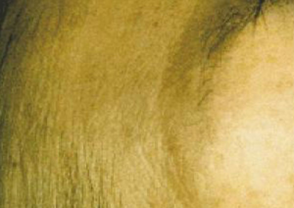 Plane Warts After - About Face Glasgow - Advanced Electrolysis Cosmetic Procedures