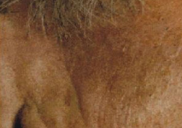 Seborrhoeic Wart After - About Face Glasgow - Advanced Electrolysis Cosmetic Procedures