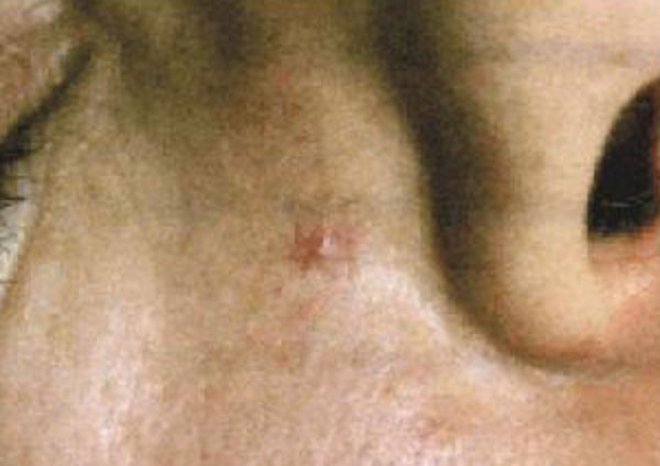 Spider Naevus Before - About Face Glasgow - Advanced Electrolysis Cosmetic Procedures