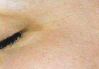 Microdermabrasion After - About Face Beauty Salon, Glasgow