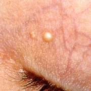 About Face Advanced Electrolysis - Milia Whiteheads
