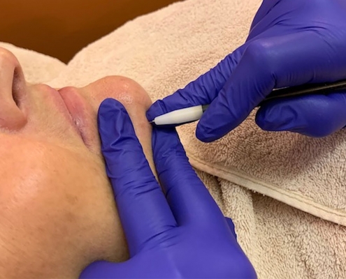 Electrolysis Hair Removal - About Face Beauty Salon, Glasgow