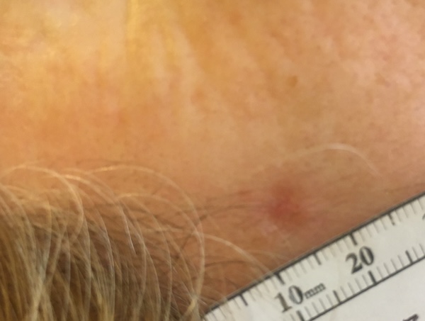 About Face Advanced Electrolysis Cosmetic Procedures for skin lesions