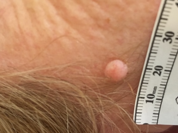 About Face Advanced Electrolysis Cosmetic Procedures for skin lesions