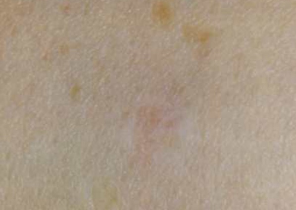 About Face Advanced Electrolysis Cosmetic Procedures for skin lesions