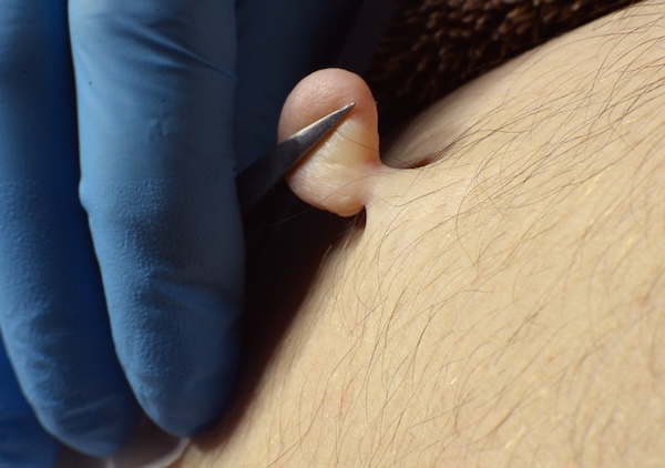 About Face Advanced Electrolysis Cosmetic Procedures for skin lesions