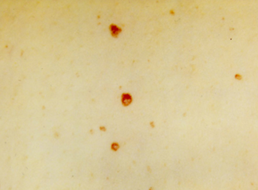 blood_spots
